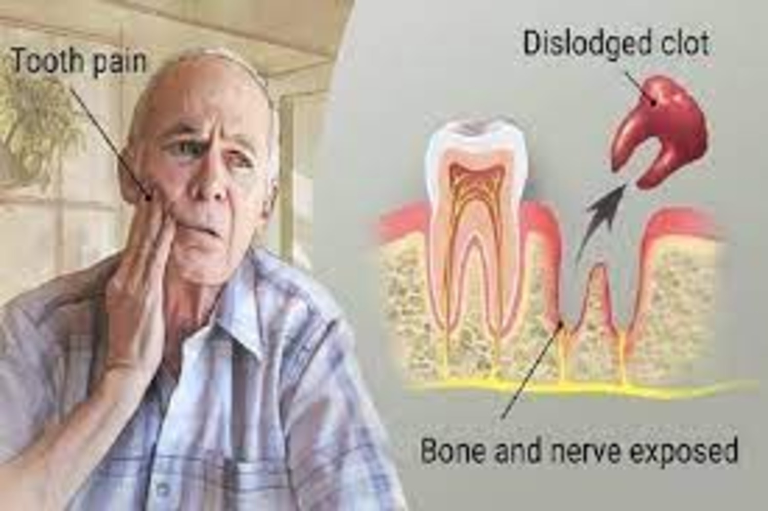 How to Smoke After Tooth Extraction Without Getting Dry Socket(1)